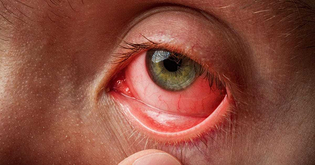 Ожоги глаз - Травмы; отравления - Справочник MSD Профессиональная версия