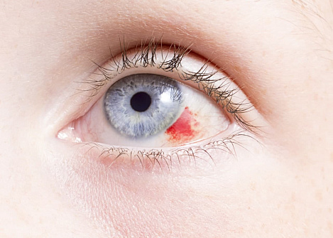 Почему лопаются сосуды на глазах и как это лечить?
