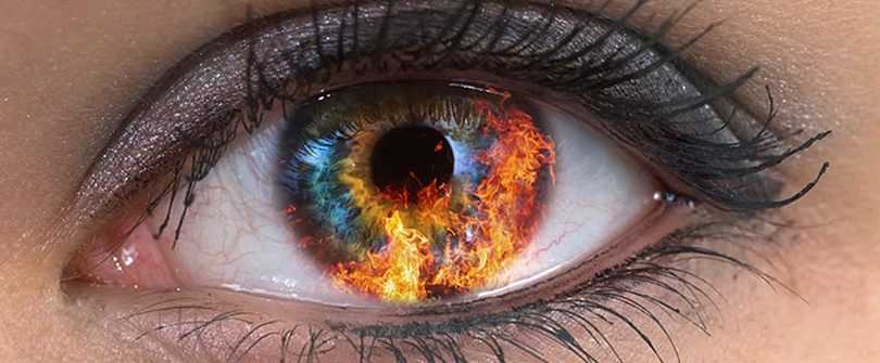Попадание в глаз извести (ожог карбидом кальция)