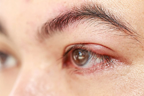 Ячмень на глазу - лечение, причины и симптомы