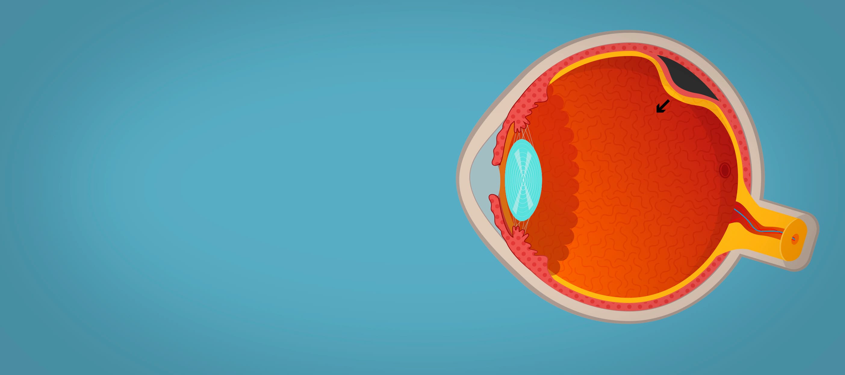 Отслоение сетчатки глаза: симптомы, лечение, причины развития и ...