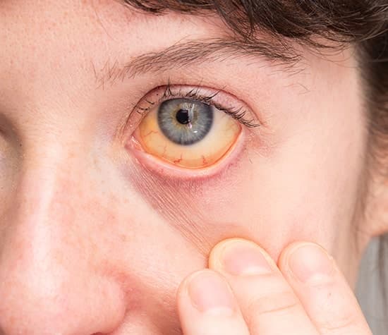Склерит глаз: причины и виды, симптомы и лечение
