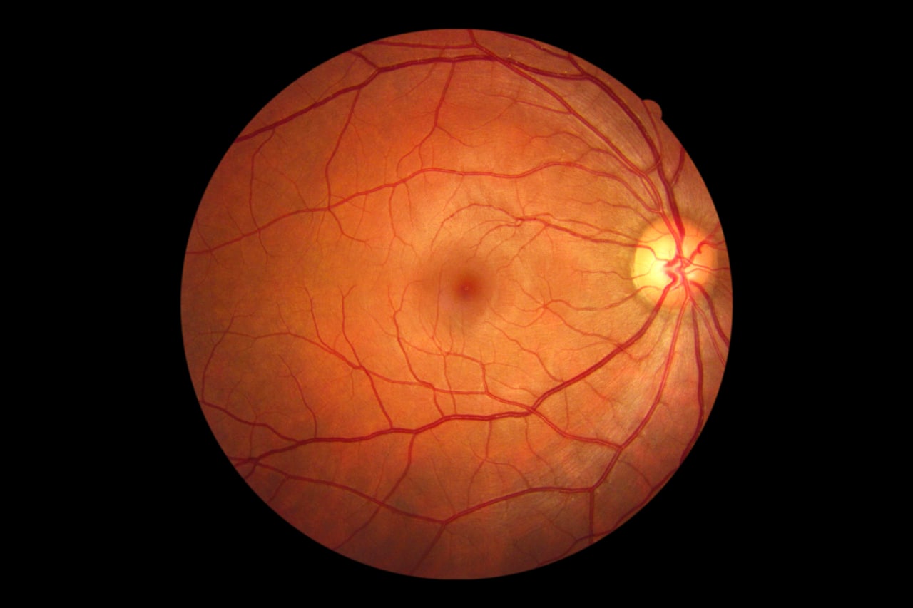 Ангиопатия сетчатки обоих глаз: что это такое, симптомы и лечение