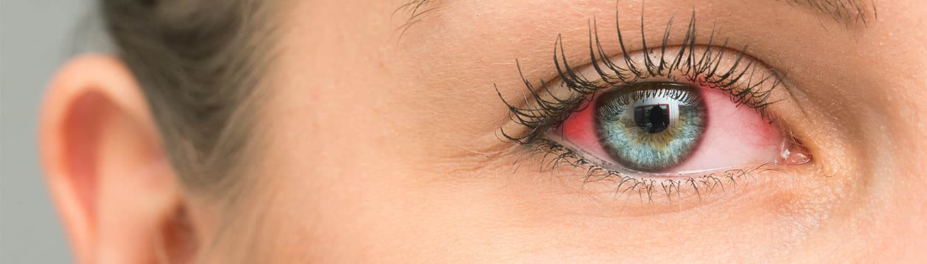 Увеит - причины, симптомы и лечение