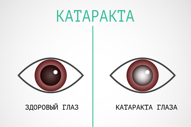 Катаракта глаза: симптомы и профилактика