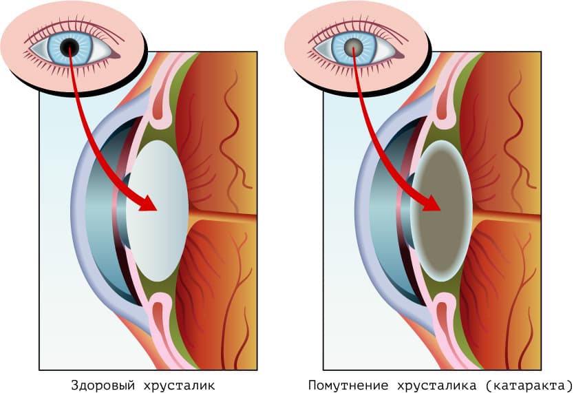 Катаракта глаза: симптомы и профилактика