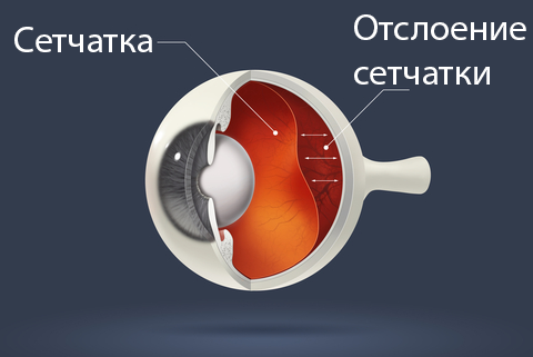 Симптомы отслоения сетчатки глаза: основные признаки и проявления