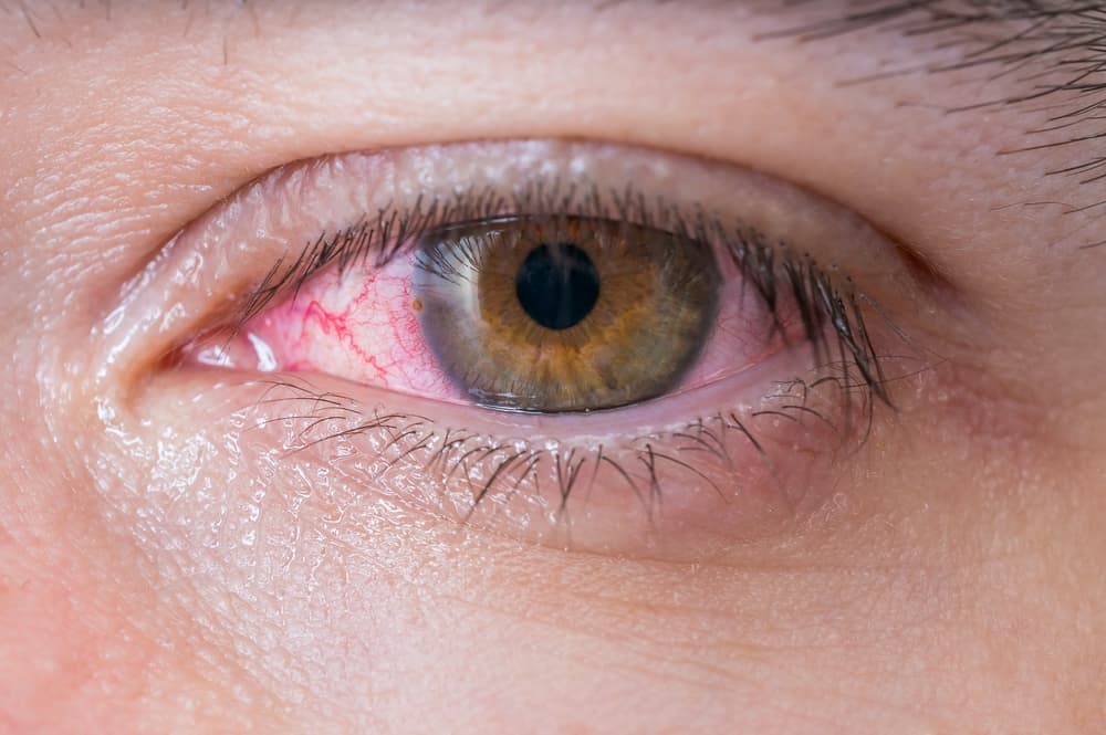 Синдром сухого глаза